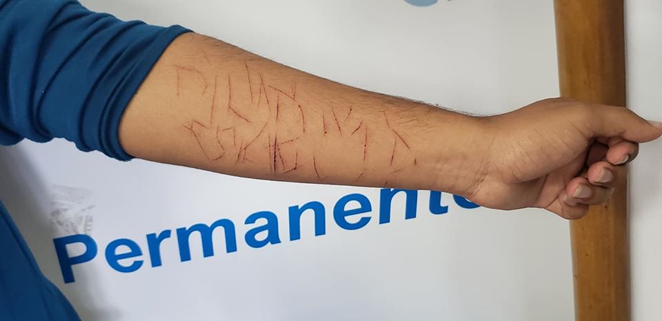 Paramilitares orteguistas golpearon a un adolescente y le marcaron en el brazo la palabra «plomo» y «el comandante se queda». Foto: Geovanny Shiffman/Artículo 66