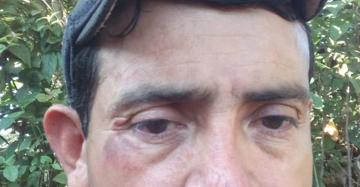 Así quedó el rostro de el excarcelado político Rubén Guido de Estelí. Foto: Cortesía / Artículo 66