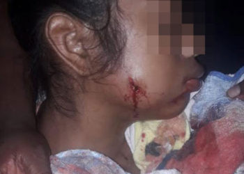 Adolescente recibió impacto de bala en su rostro tras ataque de colonos. Foto: Cortesía